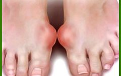 подагра ног