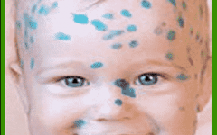 у детей краснуха