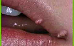 лечение папиллом