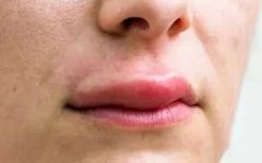 аллергия на мед